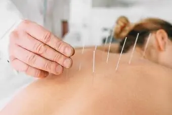 Nainen saa akupunktiohoitoa selässään