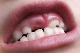 frembrudt tand